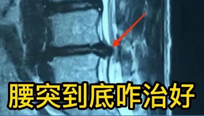 腰椎突出.png 腰椎突出.png
