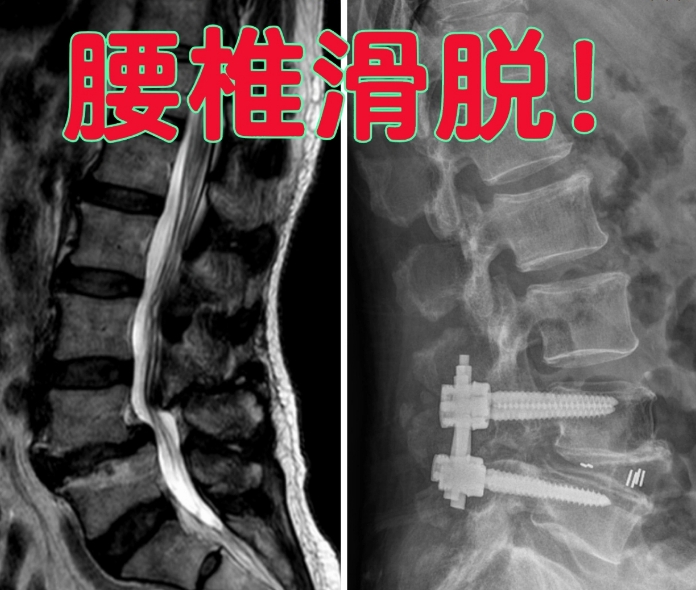 腰椎滑脱.png 腰椎滑脱.png
