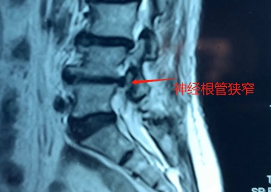 椎管狭窄.png 椎管狭窄.png