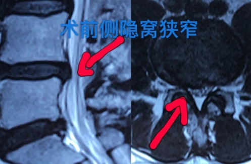 椎管狭窄.png 椎管狭窄.png