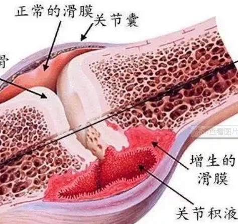 滑膜炎.png 滑膜炎.png
